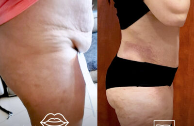 A-t-on besoin d’un déambulateur après une plastie abdominale ?