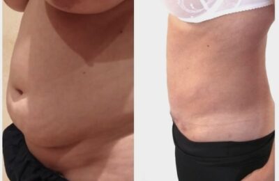 Combien d’heures faut-il pour une plastie abdominale ?