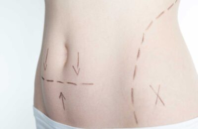 Comment savoir si une plastie abdominale est adaptée à votre cas ?