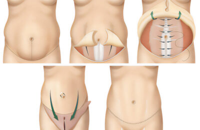 Comment se tenir droit après une plastie abdominale ?