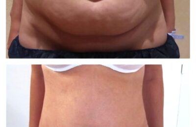 Enlève-t-on de la graisse lors d’une plastie abdominale ?