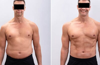 L’assurance couvre-t-elle une panniculectomie ?