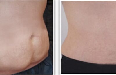 Peut-on subir une plastie abdominale si l’on est en surpoids ?