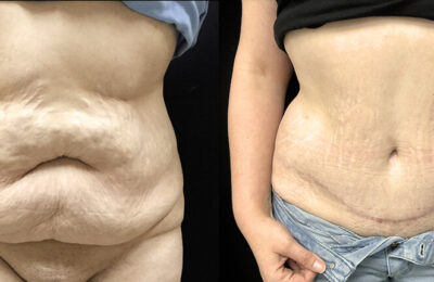 Que dois-je acheter après une plastie abdominale ?