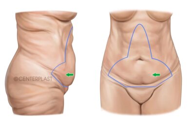 Que dois-je porter à la maison après une plastie abdominale ?